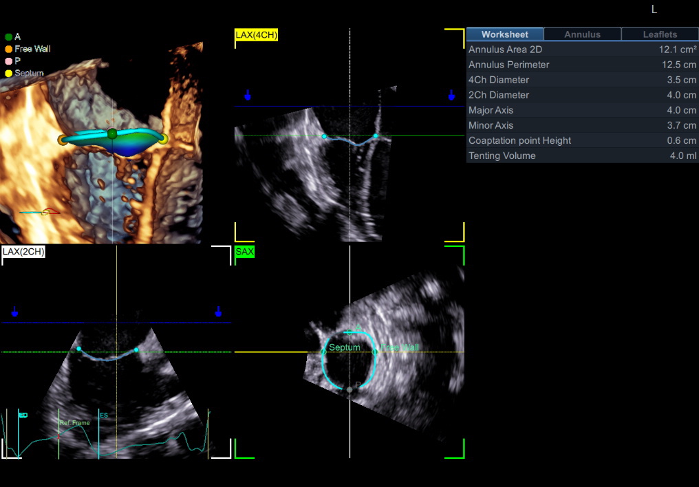 Echo Measurement