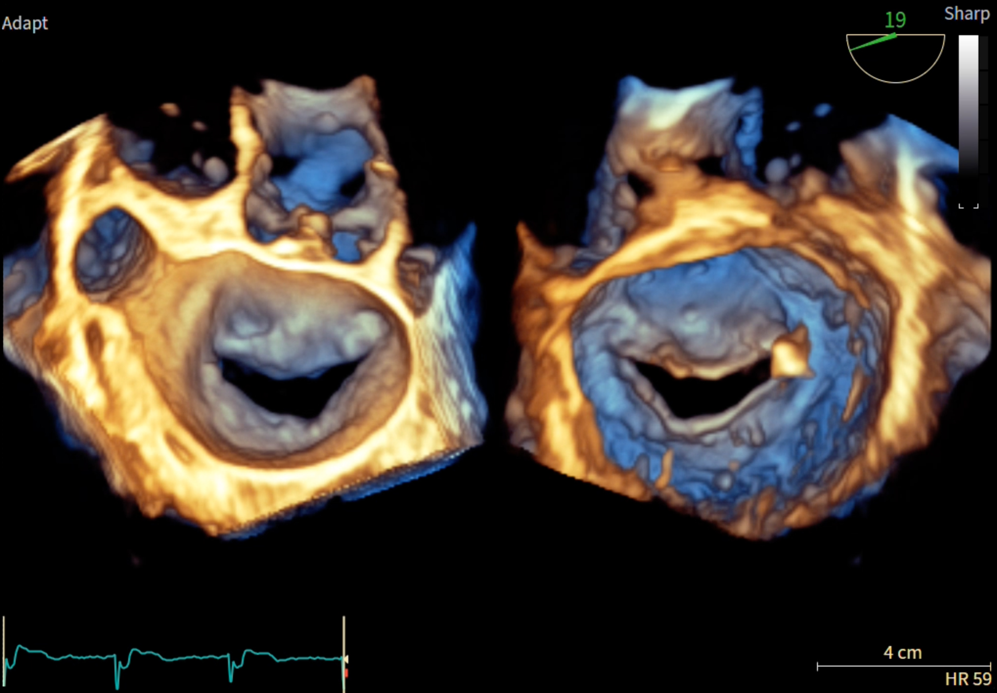 3D Echo Imaging
