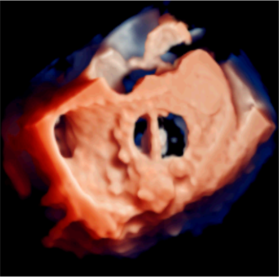 3D Echo